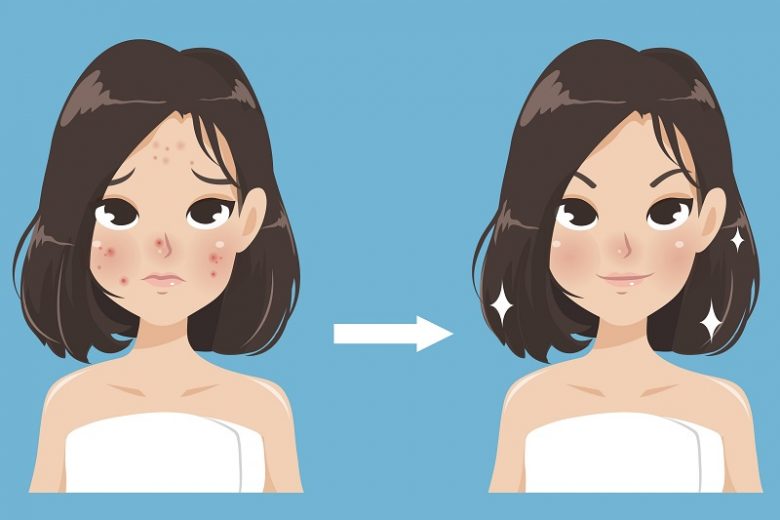 23 Cara Menghilangkan Bekas Jerawat yang Mudah dan Ampuh - Qoala Indonesia